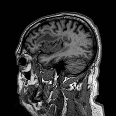 Brain metastases from lung cancer (Radiopaedia 83839-99028 Sagittal T1 28).jpg
