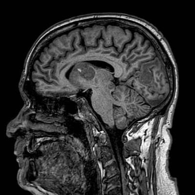 Brain metastases from lung cancer (Radiopaedia 83839-99028 Sagittal T1 58).jpg