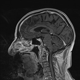 Brain metastasis (Radiopaedia 42617-45761 Sagittal T1 C+ 52).jpg