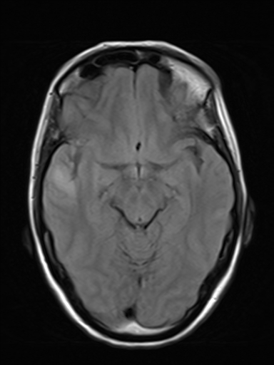 File:Brain metastasis as initial presentation of non-small cell lung cancer (Radiopaedia 65122-74126 Axial FLAIR 9).jpg