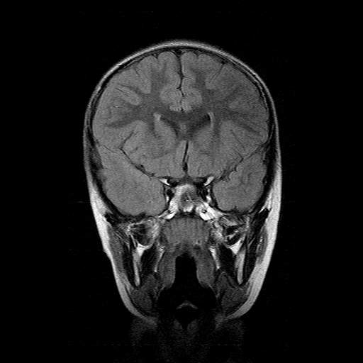 File:Brainstem ganglioglioma (Radiopaedia 10763-11224 Coronal FLAIR 13).jpg