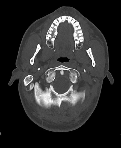 Branchial cleft cyst (Radiopaedia 31167-31875 Axial bone window 16).jpg