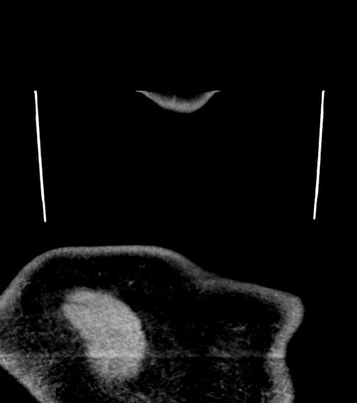 File:Branchial cleft cyst (Radiopaedia 31167-31875 Coronal C+ delayed 70).jpg