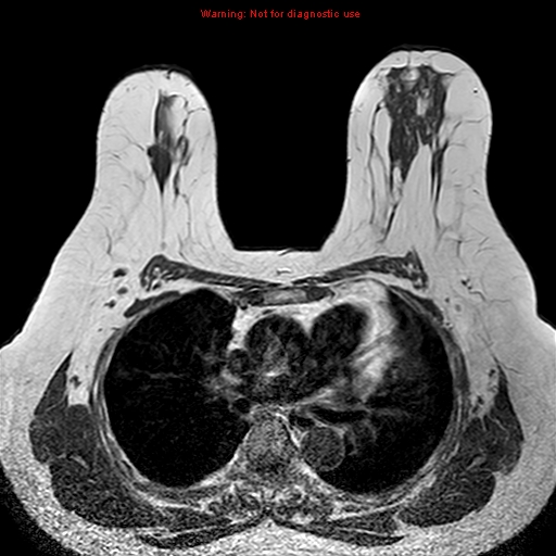 File:Breast carcinoma (multicentric multifocal in mammary Paget disease) (Radiopaedia 50966-56512 Axial T1 12).jpg