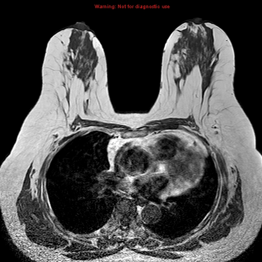 File:Breast carcinoma (multicentric multifocal in mammary Paget disease) (Radiopaedia 50966-56512 Axial T1 8).jpg