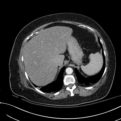 Breast carcinoma with pathological hip fracture (Radiopaedia 60314-67974 A 47).jpg
