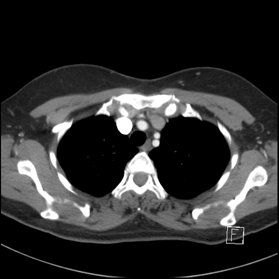 File:Breast metastases from renal cell cancer (Radiopaedia 79220-92225 A 20).jpg