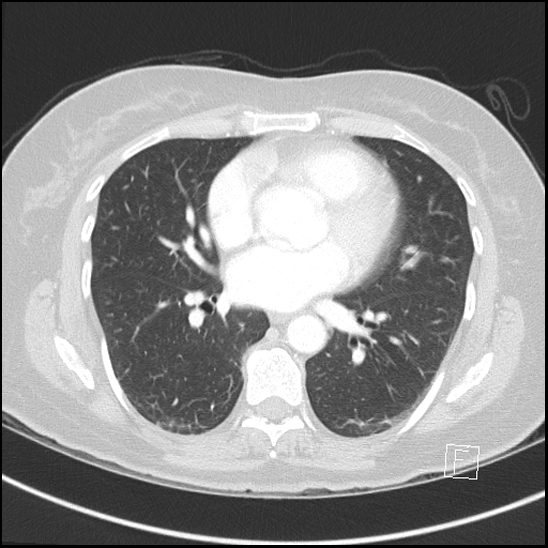 Breast metastases from renal cell cancer (Radiopaedia 79220-92225 Axial lung window 49).jpg