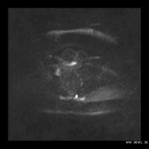 File:Broad ligament fibroid (Radiopaedia 49135-54241 Axial DWI 19).jpg
