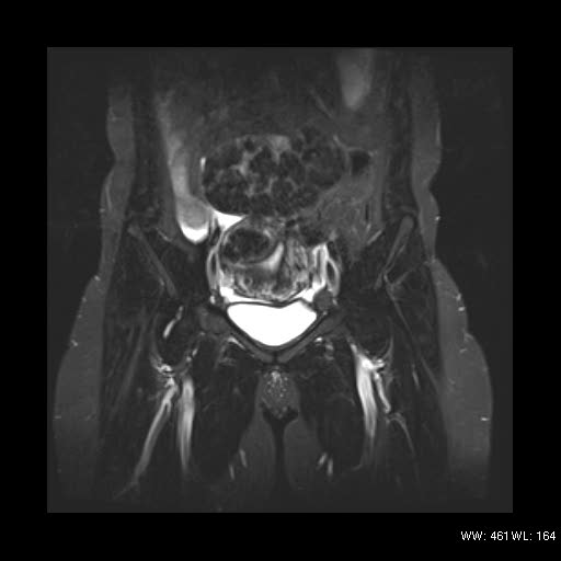 File:Broad ligament fibroid (Radiopaedia 49135-54241 Coronal STIR 9).jpg