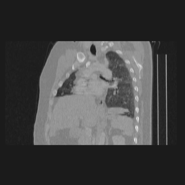 Bronchial atresia (Radiopaedia 60685-68439 Sagittal lung window 48).jpg