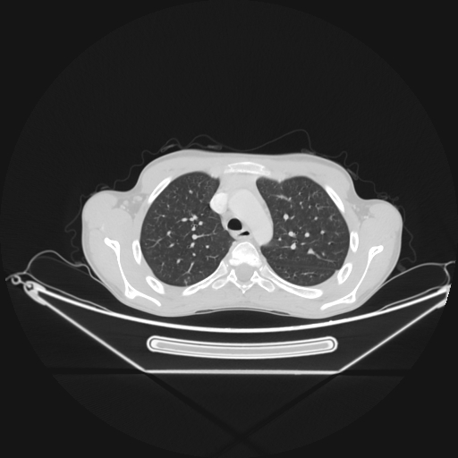 Bronchial carcinoid tumor (Radiopaedia 57187-64090 Axial lung window 18).jpg