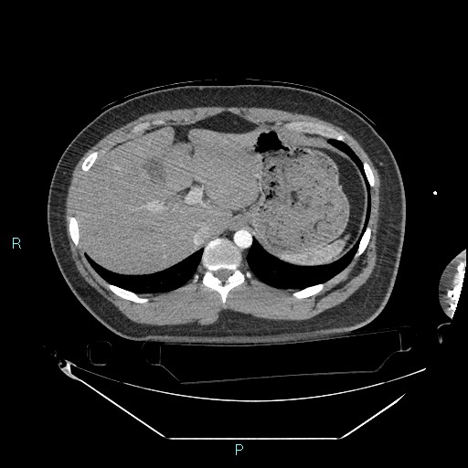 Bronchial carcinoid tumor (Radiopaedia 78272-90870 B 110).jpg