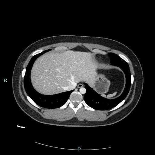 Bronchial carcinoid tumor (Radiopaedia 78272-90875 A 80).jpg