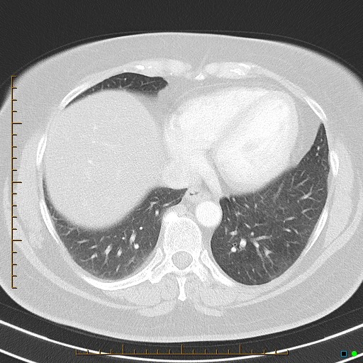 File:Bronchial diverticula (Radiopaedia 79512-92675 Axial lung window 36).jpg