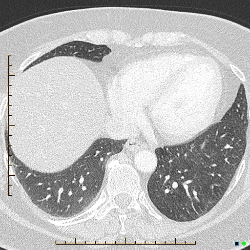 Bronchial diverticula (Radiopaedia 79512-92676 Axial lung window 155).jpg
