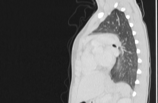Bronchial mucoepidermoid carcinoma (Radiopaedia 57023-63895 Sagittal lung window 117).jpg