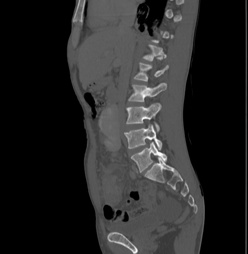 Bronchiectasis in Crohn disease (Radiopaedia 60311-67977 Sagittal bone window 100).jpg