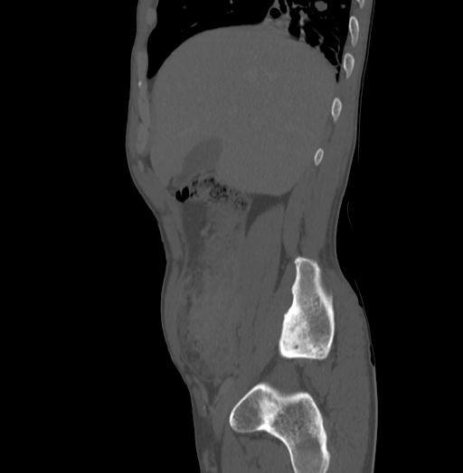 Bronchiectasis in Crohn disease (Radiopaedia 60311-67977 Sagittal bone window 49).jpg