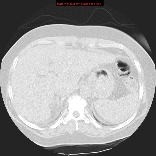 Bronchoalveolar carcinoma (Radiopaedia 13224-13233 Axial lung window 41).jpg
