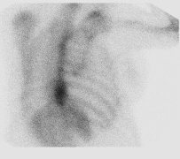 File:Bronchoalveolar carcinoma (Radiopaedia 13224-13234 A 8).jpg