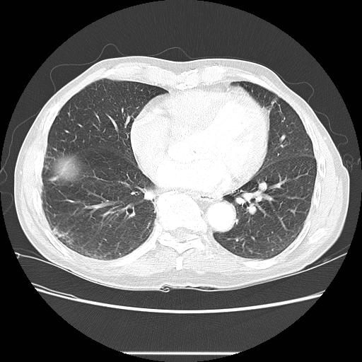 Bronchocele (Radiopaedia 17097-16795 Axial lung window 78).jpg