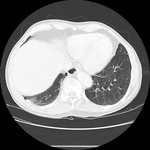 Bronchocele (Radiopaedia 17097-16795 Axial lung window 94).jpg