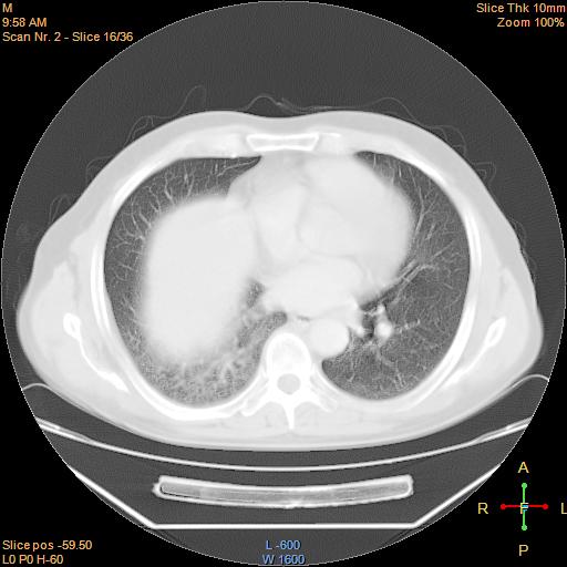 File:Bronchogenic carcinoma with superior vena caval invasion (Radiopaedia 22378-22406 lung window 13).jpg