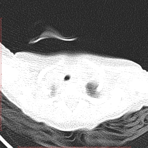 Bronchogenic cyst (Radiopaedia 78599-91409 Axial lung window 19).jpg