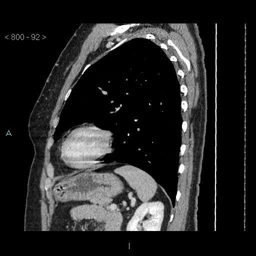 Bronchogenic cyst - posterior mediastinal (Radiopaedia 43885-47364 B 61).jpg