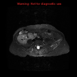 File:Brown tumors (Radiopaedia 9666-10290 Axial T2 fat sat 1).jpg