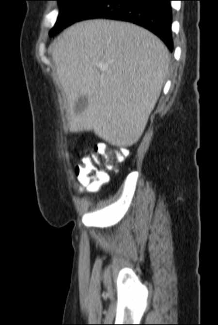 Brown tumors compressing the spinal cord (Radiopaedia 68442-77988 F 12).jpg