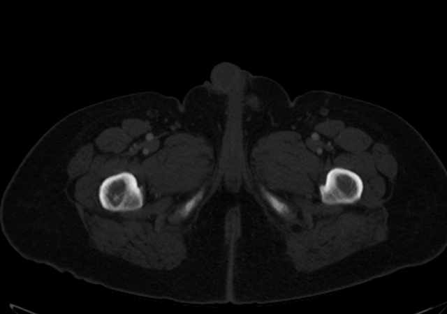 Brown tumors compressing the spinal cord (Radiopaedia 68442-77988 G 142).jpg