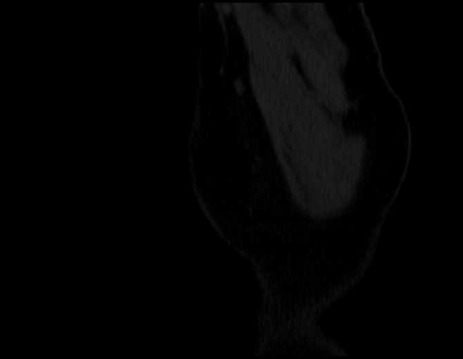 Brown tumors compressing the spinal cord (Radiopaedia 68442-77988 Sagittal bone window 1).jpg