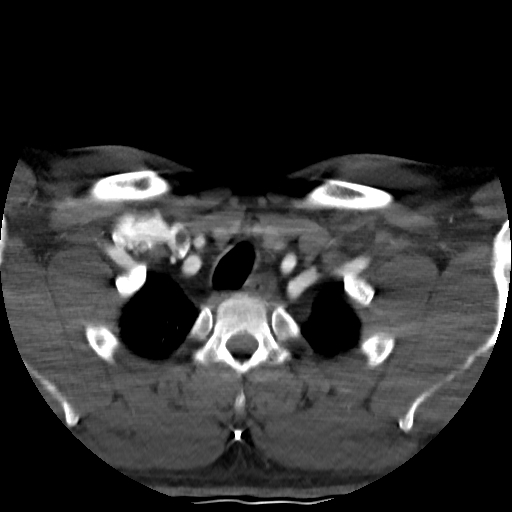 Buccal fat pad arteriovenous malformation (Radiopaedia 70936-81144 A 97).jpg