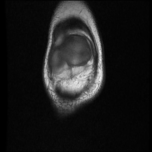 File:Bucket handle tear - lateral meniscus (Radiopaedia 72124-82634 Coronal T1 2).jpg