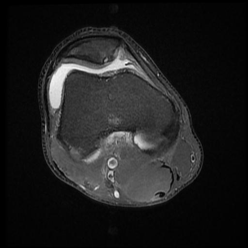 File:Bucket handle tear - medial meniscus (Radiopaedia 69245-79026 Axial PD fat sat 5).jpg