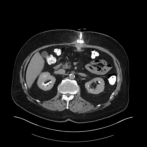 File:Buried bumper syndrome - gastrostomy tube (Radiopaedia 63843-72575 Axial Inject 9).jpg