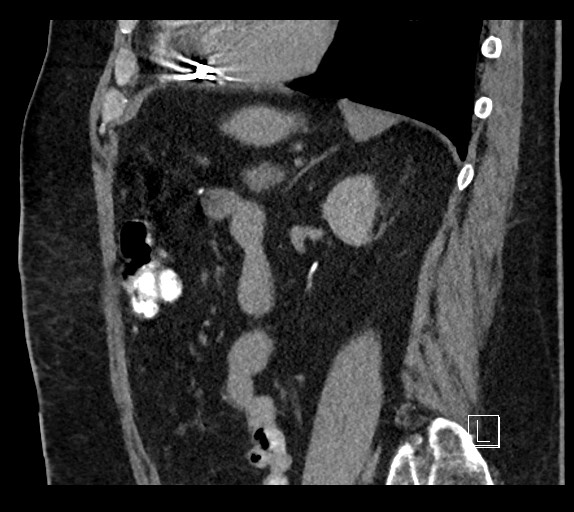 Buried bumper syndrome - gastrostomy tube (Radiopaedia 63843-72577 Sagittal Inject 40).jpg