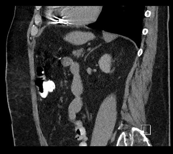Buried bumper syndrome - gastrostomy tube (Radiopaedia 63843-72577 Sagittal Inject 41).jpg