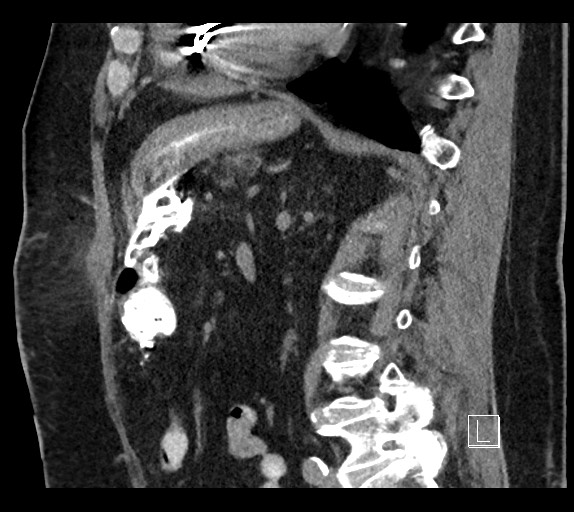 Buried bumper syndrome - gastrostomy tube (Radiopaedia 63843-72577 Sagittal Inject 49).jpg
