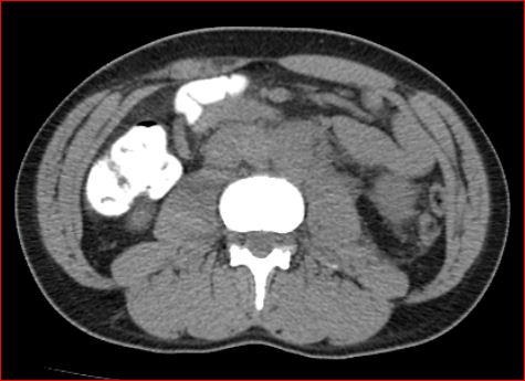 File:Burned-out testicular choriocarcinoma (Radiopaedia 32822-34040 Axial non-contrast 13).jpg