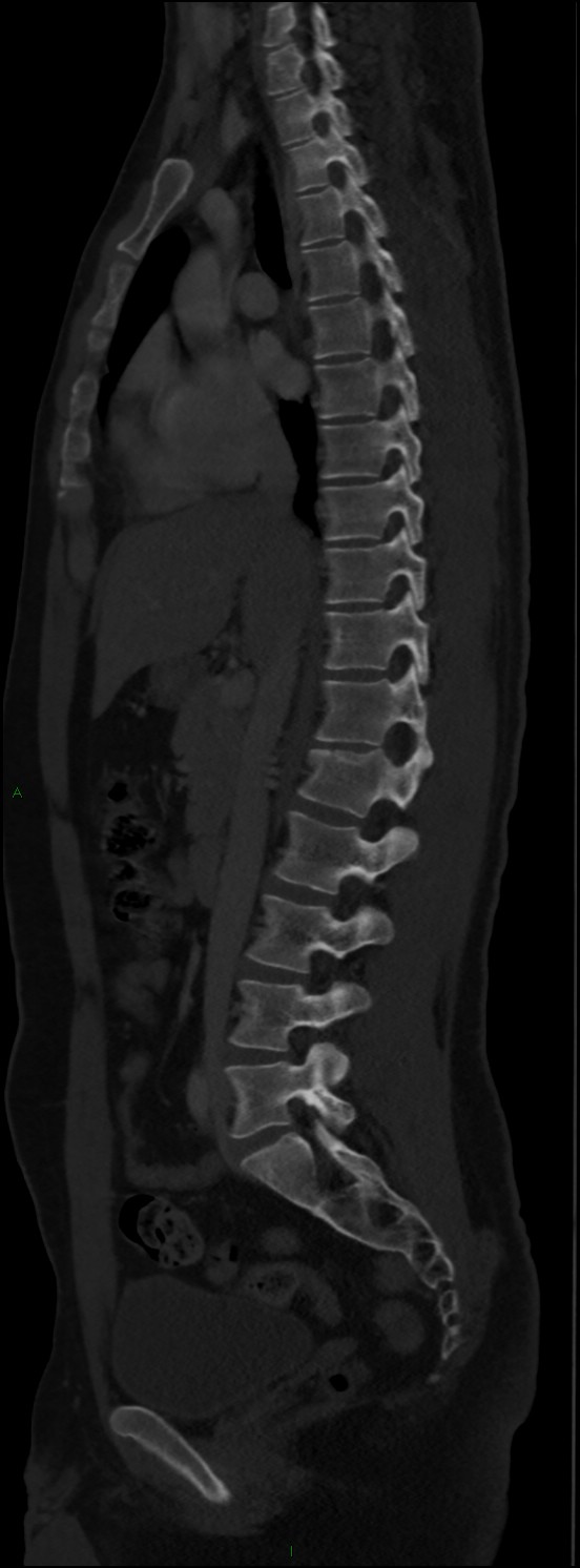 Burst fracture (Radiopaedia 83168-97542 Sagittal bone window 63).jpg