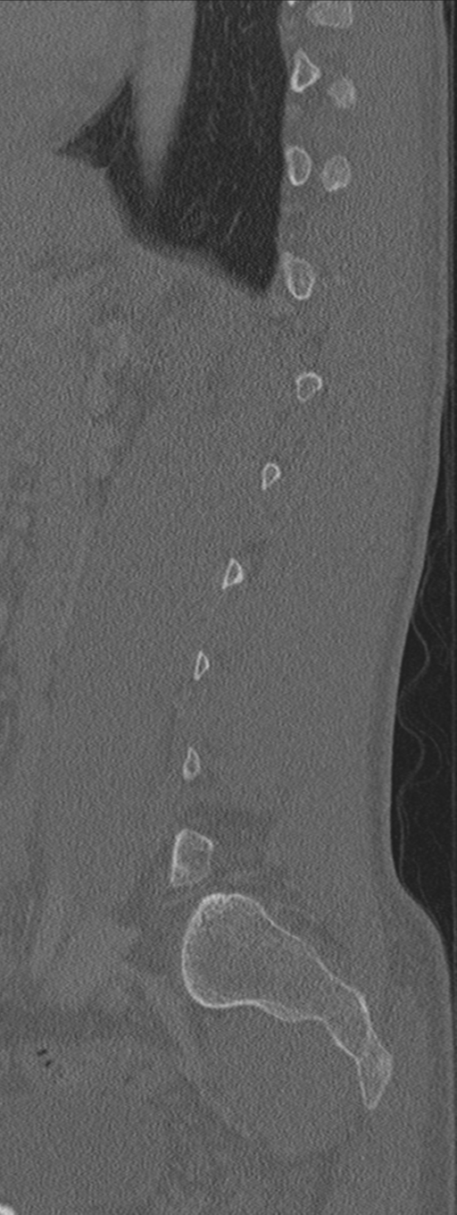 Burst fracture - T12 with conus compression (Radiopaedia 56825-63647 Sagittal bone window 23).png
