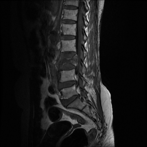 File:Burst fracture - lumbar spine (Radiopaedia 72877-83541 Sagittal T1 4).jpg