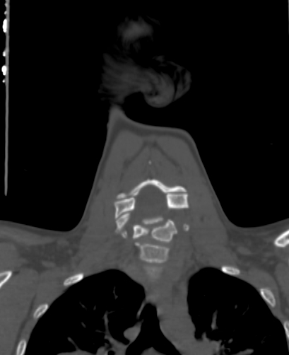 File:Butterfly vertebra (Radiopaedia 77903-90209 Coronal bone window 35).jpg
