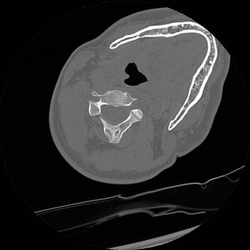 C1-C2 "subluxation" - normal cervical anatomy at maximum head rotation (Radiopaedia 42483-45607 Axial non-contrast 25).jpg