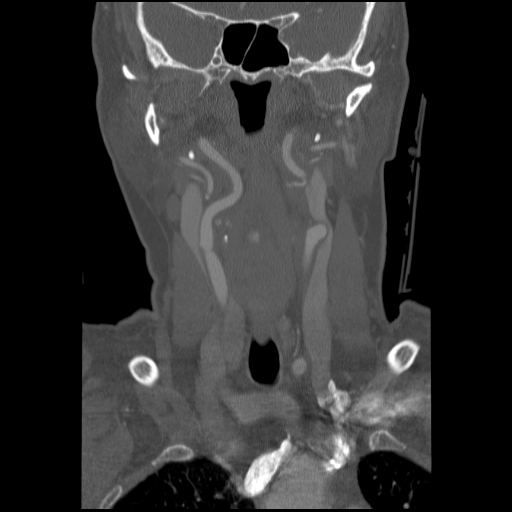 C1 anterior arch (plough) fracture - type 1 (Radiopaedia 76181-87720 Coronal bone window 69).jpg