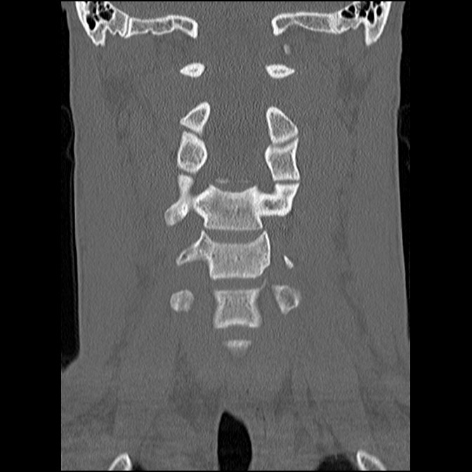 C5 facet fracture (Radiopaedia 58374-65499 Coronal bone window 28).jpg