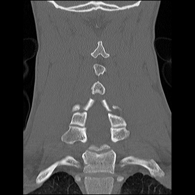 C5 facet fracture (Radiopaedia 58374-65499 Coronal bone window 38).jpg